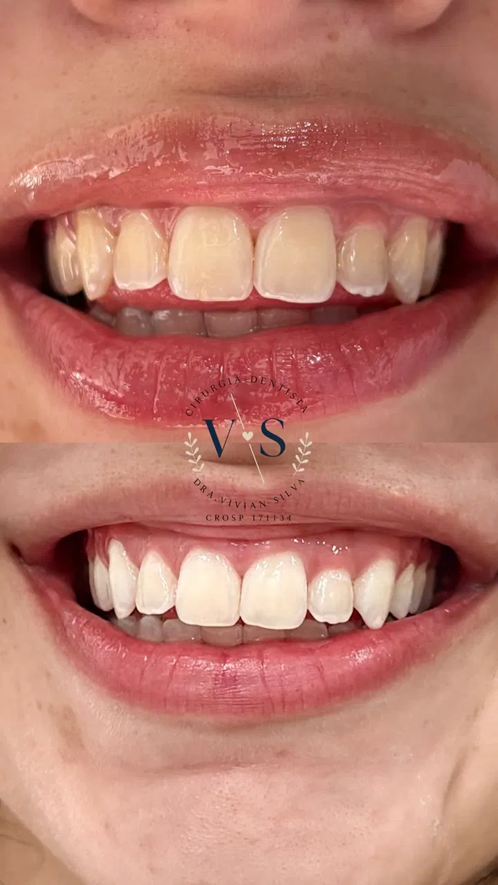 Antes e depois — Clareamento