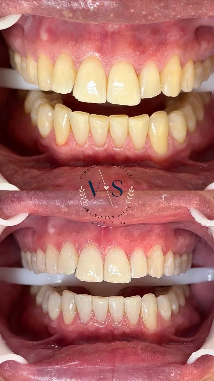 Antes e depois — Clareamento
