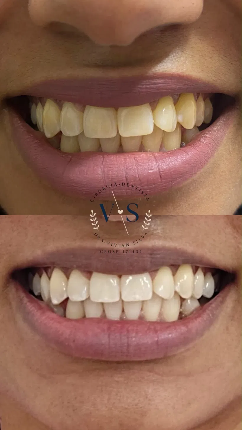 Antes e depois — Clareamento