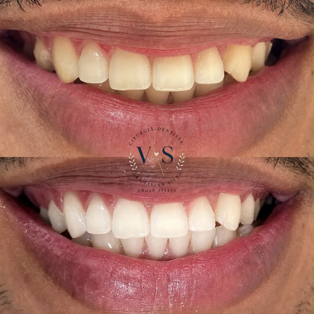 Antes e depois — Clareamento