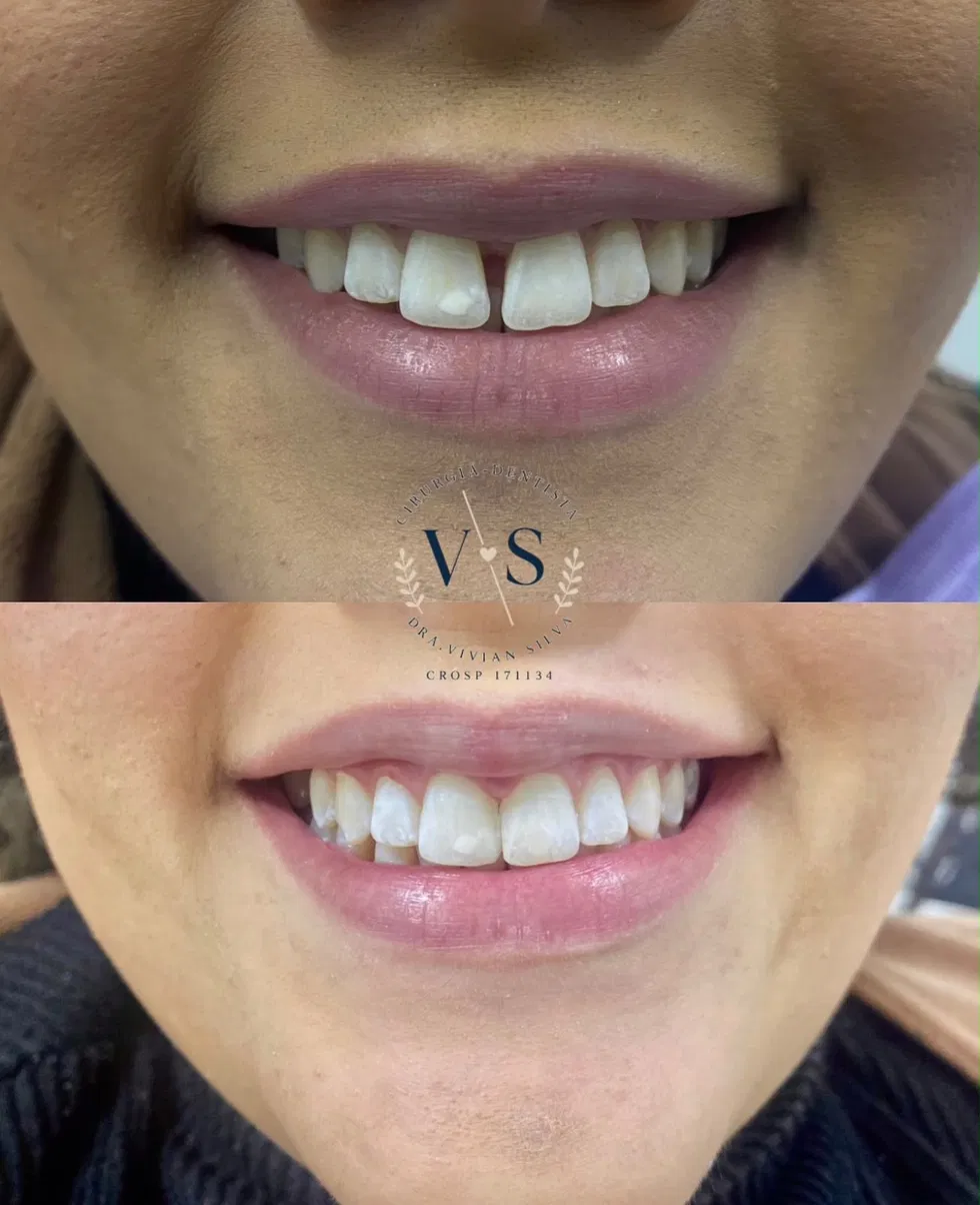 Antes e depois — Clareamento e fechamento de espaço entre os dentes (diastema)