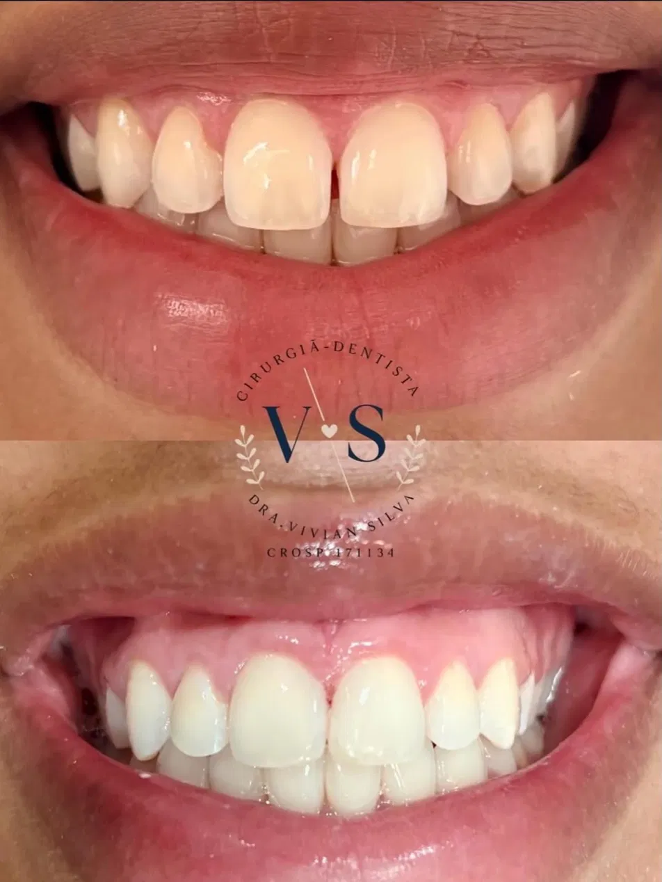 Antes e depois — Clareamento e fechamento de espaço entre os dentes (diastema)